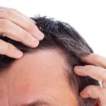 tratamiento médico capilar para la alopecia