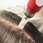 «Beneficios de la mesoterapia capilar»