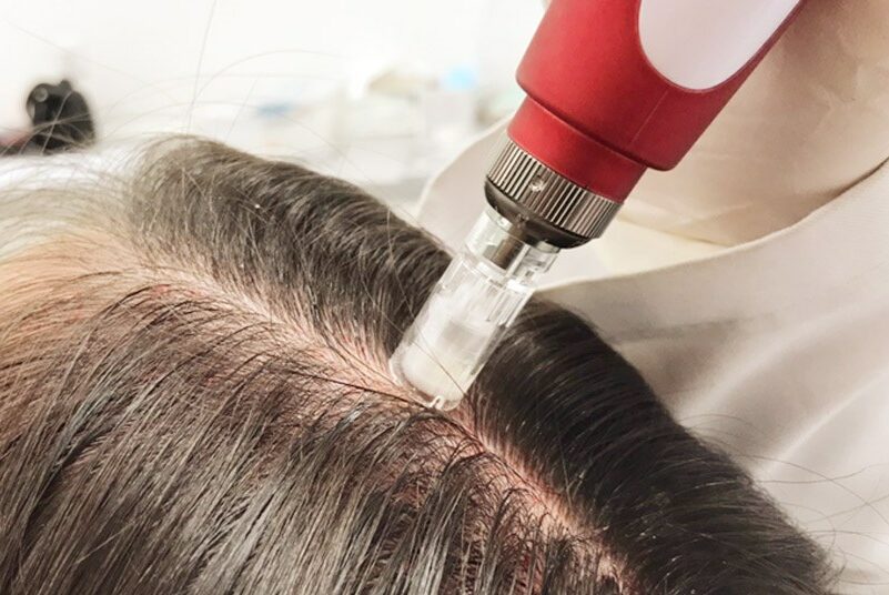 «Beneficios de la mesoterapia capilar»