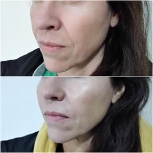 Antes y después del aumento de pómulos, se nota cómo se proyectan mejor los pómulos y barbilla mejorando la armonía del rostro