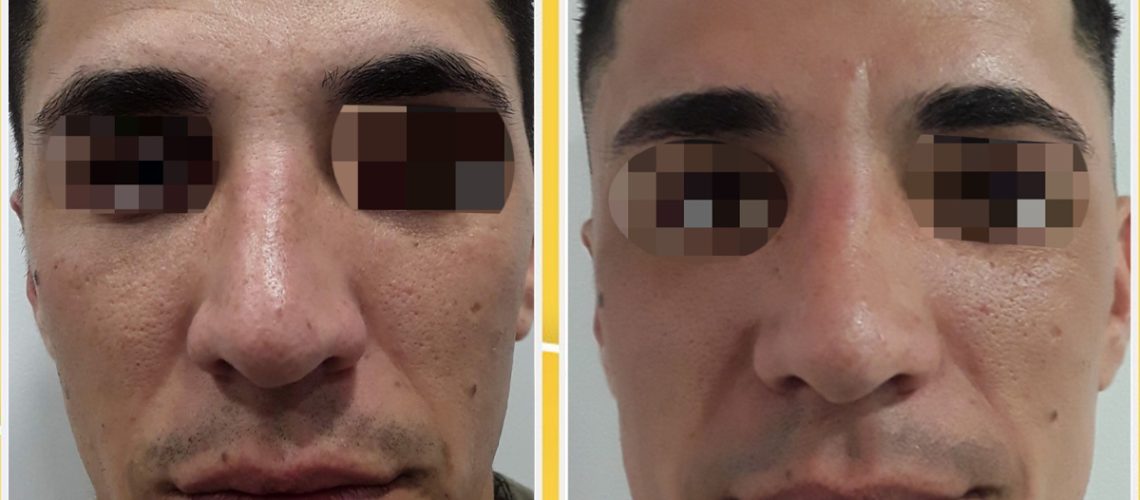 masculinización de las facciones del rostro tratamiento de medicina estética