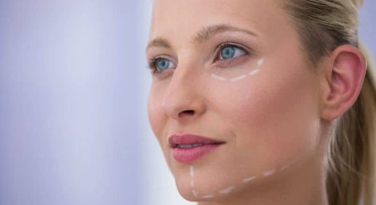 eliminar-la-flacidez-del-cuello-con-lipolaser Mujer con marcas en el párpado inferior, mandíbula y mentón para eliminar la flacidez del cuello con lipolaser